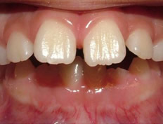 Phase I (mixed dentition) of severe overbite (Herbst appliance)