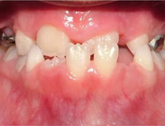 Phase I (Mixed dentition) Underbite correction (Palate expander and headgear)